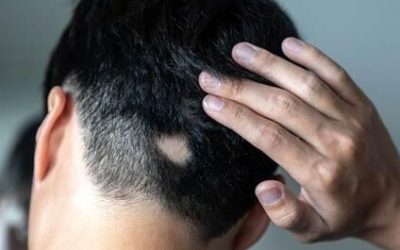 Alopecia areata cause e rimedi